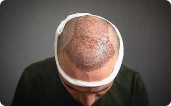 Hair Transplant in Tiruvannamalai