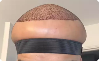 Hair Transplant in Tiruvannamalai