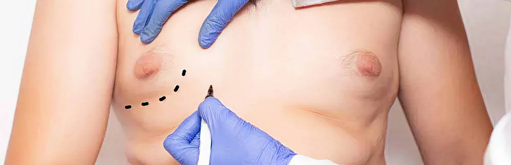 Gynecomastia Treatment in Tiruvannamalai
