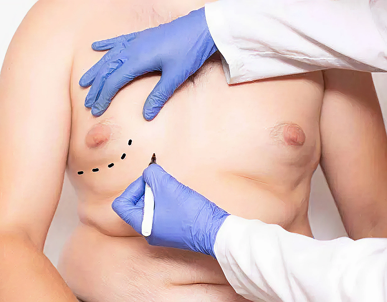 Gynecomastia Treatment in Tiruvannamalai