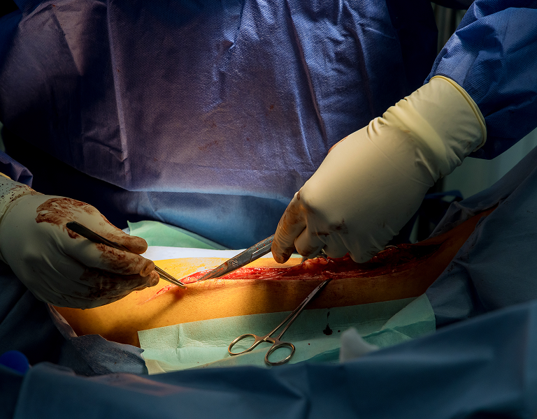 Gynecomastia Treatment in Tiruvannamalai