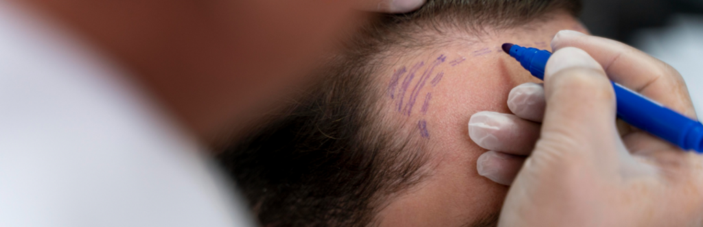 Hair Transplant in Tiruvannamalai