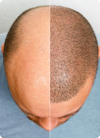 Hair Transplant in Tiruvannamalai
