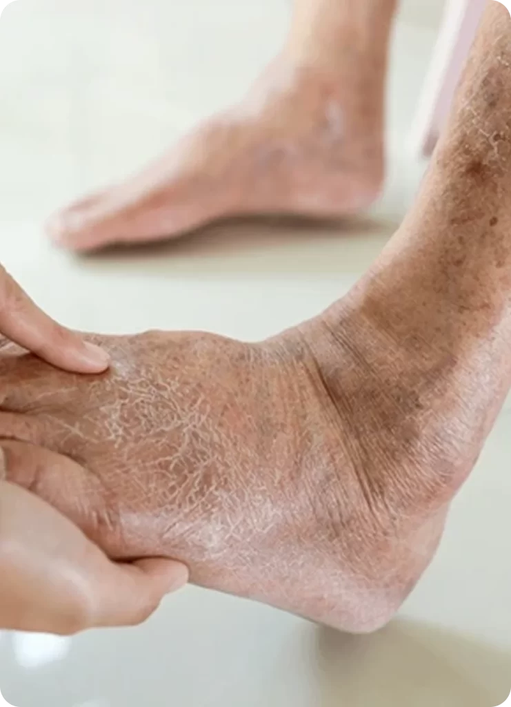 Diabetic Foot Care in Tiruvannamalai