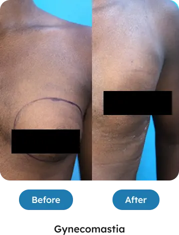 Gynecomastia