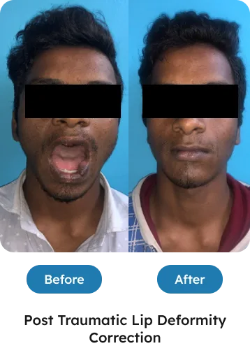 Post traumatic lip deformity correction