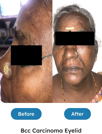 BCC Carcinoma Eyelid