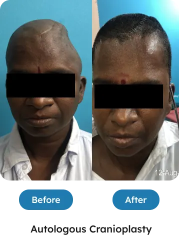 Autologus cranioplasty