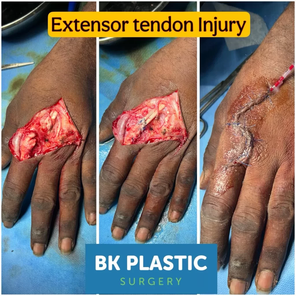 Extensor tendon Injury